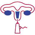 Indira IVF Hysteroscopy